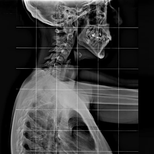 cifosis xray Especialista en Cifosis en Tepic
