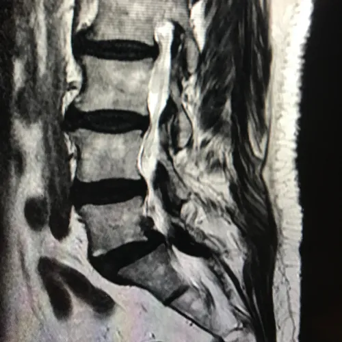 especialista espondilolistesis
